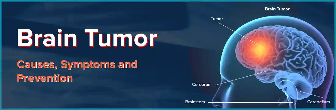  Brain Tumor: Causes, Symptoms and Prevention